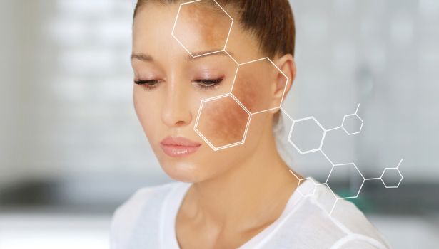 hyperpigmentation
