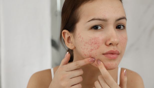 person with acne